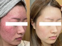 リジュ(Reje)/赤みケア