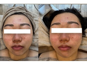 ジュエルオーキッド(Jewel orchids)/ハーブピーリング×プラズマ