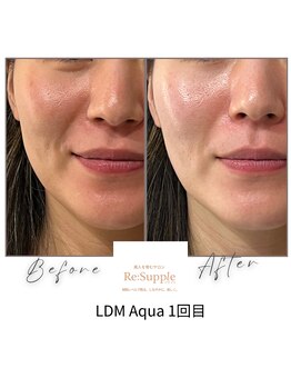 リサプリ(Re: Supple)/集中シワ・たるみ・水光感