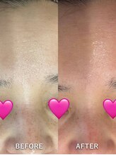 ベルミーランド MEGAドン・キホーテ草加/エステダーマBefore→After