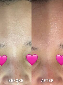 ベルミーランド MEGAドン・キホーテ草加/エステダーマBefore→After