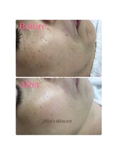 ミサズ スキンケア(misa's skin care)/ビフォー／アフター 50代