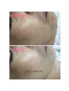 ミサズ スキンケア(misa's skin care)/ビフォー/アフター 50代