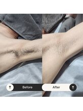 ユーフェム(U-fem)/ワキ3回目のお客様