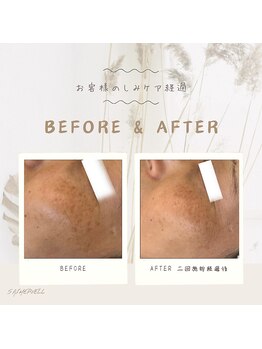 セメヴェール(Saimervell)/シミの根本から改善しましょう☆