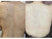 【20代】背中が空いた服も自信をもって着る事ができるように☆☆