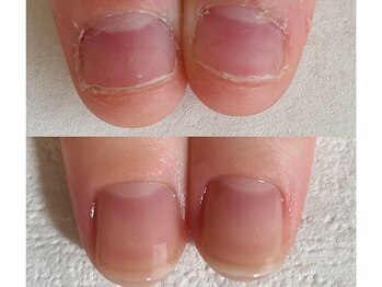 シーネイル(C Nail)/深爪のお悩みも◎