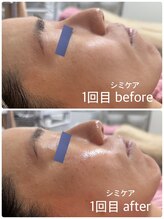 リエル(Liel)/低周波シミケア　施術写真１回目