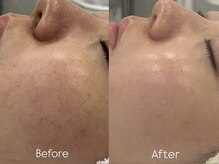 リフコウベ(LIF KOBE)/毛穴黒ずみ◇ハーブピーリング