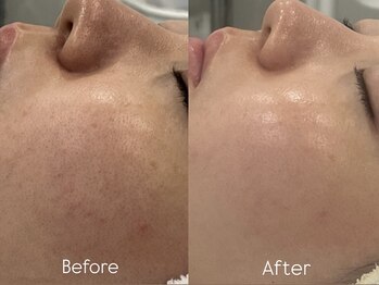 リフコウベ(LIF KOBE)/毛穴黒ずみ◇ハーブピーリング