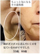 カラーズ(callas)/深いほうれい線の老け見えの変化