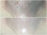 【毛穴詰まり黒ずみ】毛穴改善+肌悩み別パック付きで水光肌