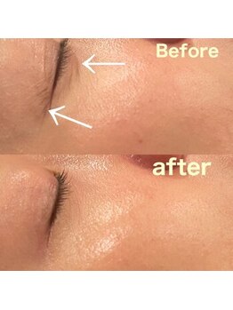 プルネ(Purune)/ハイドラ＊シミ・シワ改善