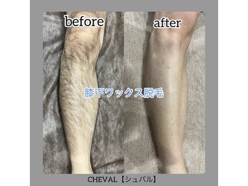 シュバル(CHEVAL)/膝下ワックス脱毛