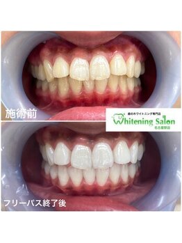 ホワイトニングサロン 名古屋駅店/【ホワイトニング施術例】
