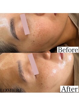 ロミエール 南草津店(LOMIERE)/セルマン★滋賀初！艶玉肌