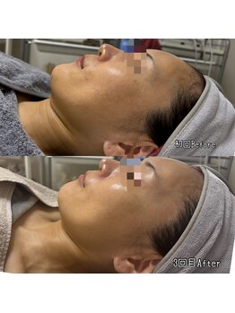 オルオル 天神大名店(Olu-.olu.)/肌質改善しみ改善/小顔/ツヤ肌