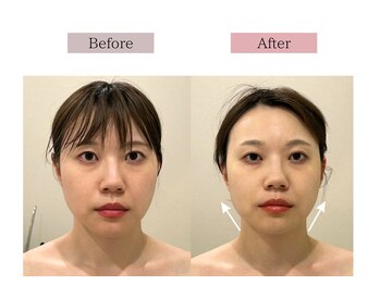 フロリール アザブジュウバン(FlorirAzabujuban)/小顔フェイシャル/リフト