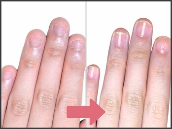 アモ 坂戸(’Amo)/深爪矯正・自爪育成 坂戸/北坂戸