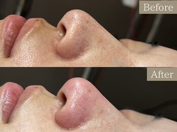 ティーツリー 名古屋 桜山(Tea Tree)/【毛穴ケア・毛穴洗浄】