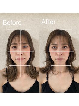 アリス(Alice)/小顔矯正 Before / After