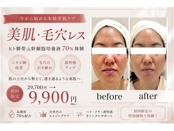 イーズ ミュゼ  ららぽーと横浜店の写真/高濃度ヒト臍帯血由来の幹細胞導入＆フェイシャルマッサージ・極上ネックマッサージで満足度NO1コース！