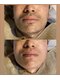 ストック(STOCK)の写真/髭脱毛経験者の9割が言う。『もっと早くやればよかった』