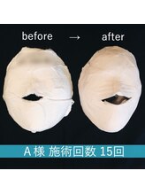 レビーリズ バイ サロンリーナ(Revie Liz)/骨造(コルゾウ)後の石膏パック