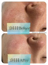 ミサズ スキンケア(misa's skin care)/ビフォー/アフター　20代