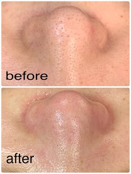 サロンこころ/1回でこの効果！毛穴ケア