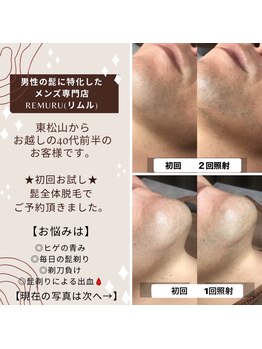 リムル(REMURU)/1回2回でも髭の密度に変化