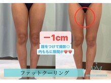 リメイクビューティークリニック(REMAKE BEAUTY CLINIC)/【施術症例】脂肪冷却