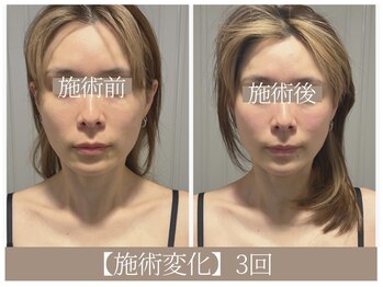 ドクターボディ 恵比寿店(Dr.Body)/【ほおコケ/顔の長さ短く 30代】