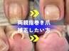 【巻き爪・陥入爪ケア】（両親指）痛みから解放！見た目も綺麗に◎