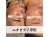 【人気No.1】《ニキビケア専用》ハーブピーリング+生酵素1g+小顔矯正
