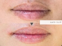 クリード(CLEAD)/ルメラリップ/¥55000クリーム付