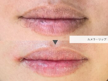 クリード(CLEAD)/ルメラリップ/¥55000クリーム付