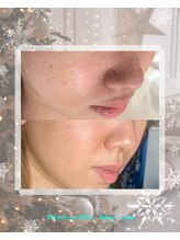 リレア ラカ(Relair Laka)/ハーブピーリングで毛穴ケア