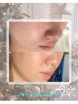 リレア ラカ(Relair Laka)/ハーブピーリングで毛穴ケア