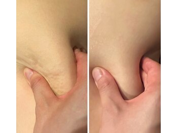 アクアリジェ/脂肪分解レモンボトル導入1回