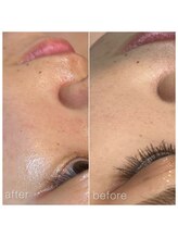 ツルル 岡崎店(TSURURU)/【毛穴水素洗浄】