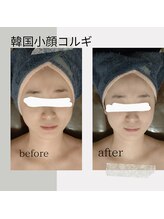 ウララン(URARAN)/小顔コルギ＋光フェイシャル