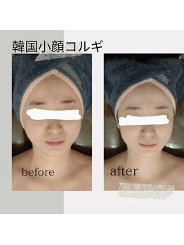 ウララン(URARAN)/小顔コルギ＋光フェイシャル