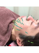 よつば鍼灸整骨院 春日院/美容鍼