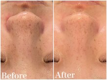 サロンドフェイス(Salon de Faith)/ハーブピーリング