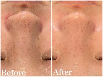 サロンドフェイス(Salon de Faith)/ハーブピーリング