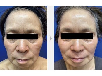 Nビューティー/最新RFサーモシェイプオーパス