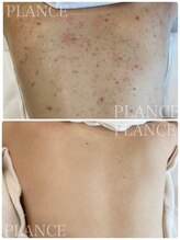 プランス 渋谷(PLANCE)/毛穴/ハーブ/ニキビケア