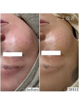 モンクラッシー(Mon classy)/数あるシミも薄く