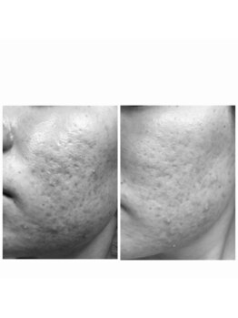 ポアレ(POARE)/POARE大人気肌育リペ